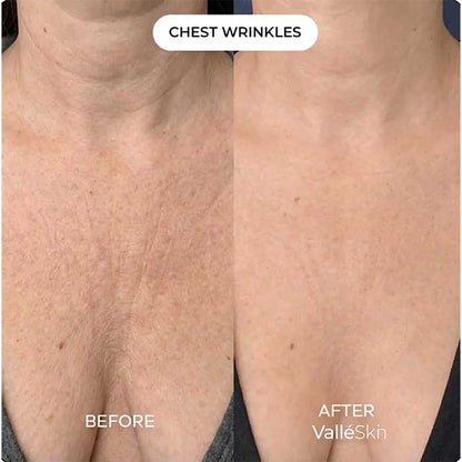 Collagen Chest Mask ValléSkin