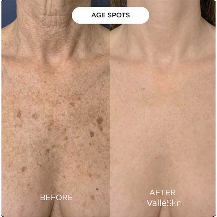 Collagen Chest Mask ValléSkin