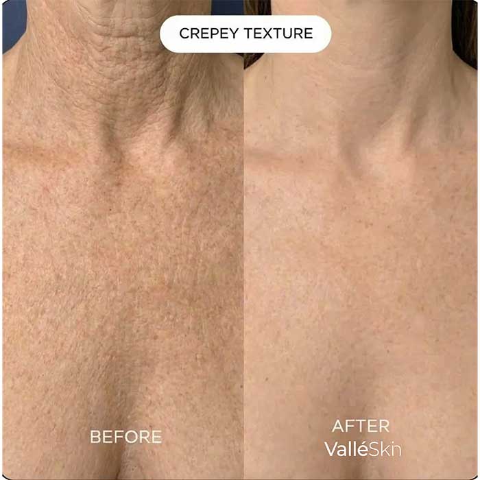 Collagen Chest Mask ValléSkin