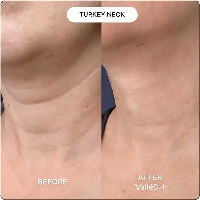 Collagen Neck Mask ValléSkin