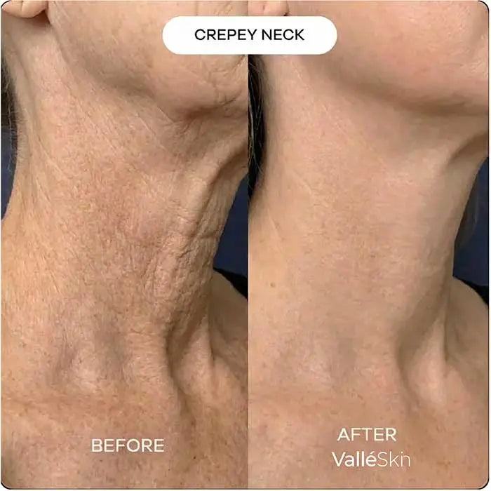 Collagen Neck Mask ValléSkin