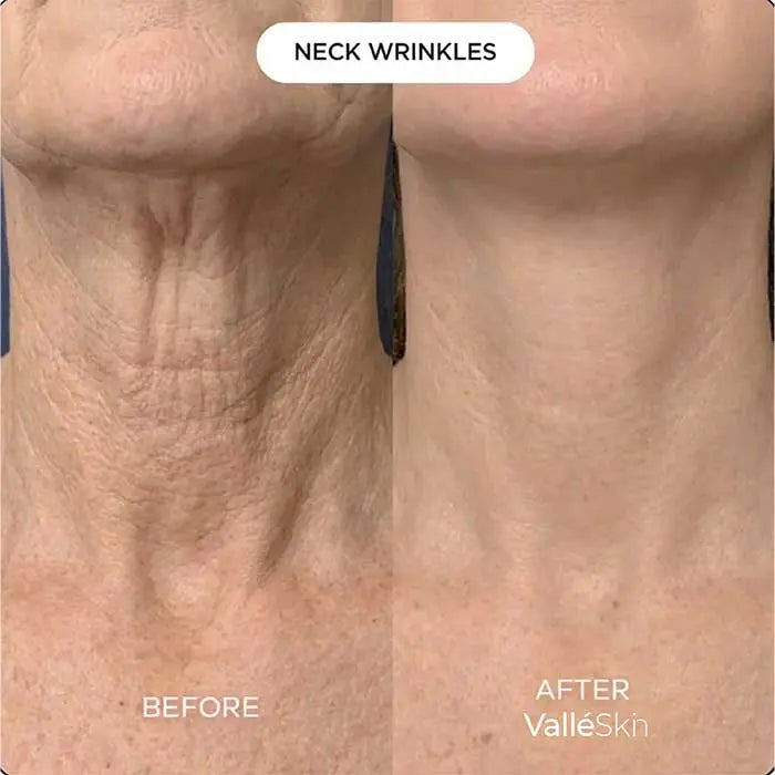 Collagen Neck Mask ValléSkin