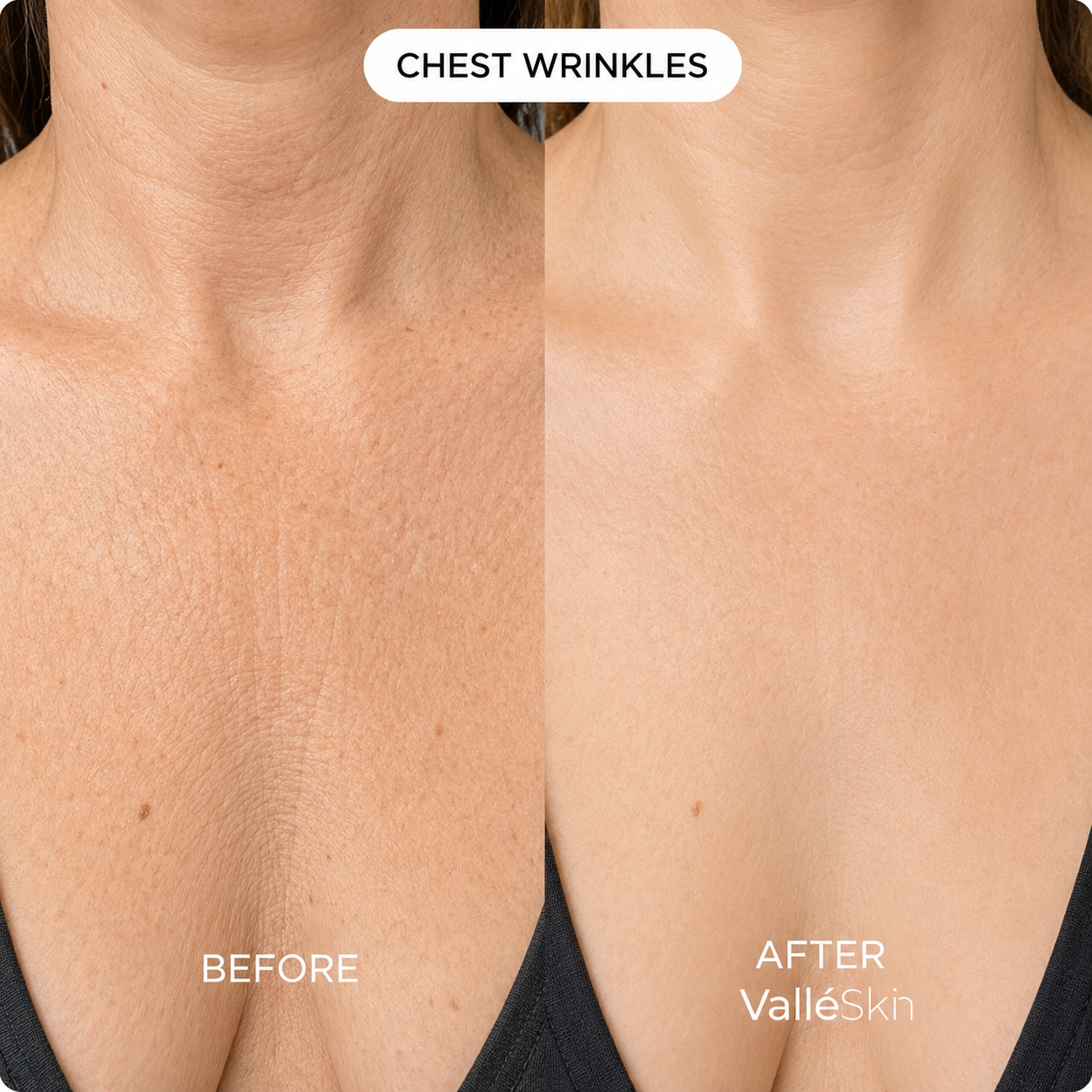 Collagen Chest Mask ValléSkin