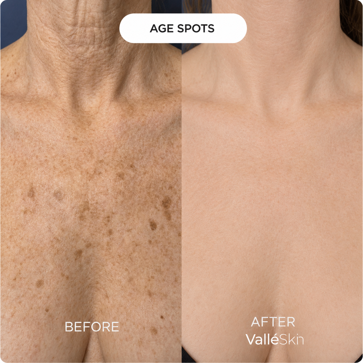Collagen Chest Mask ValléSkin