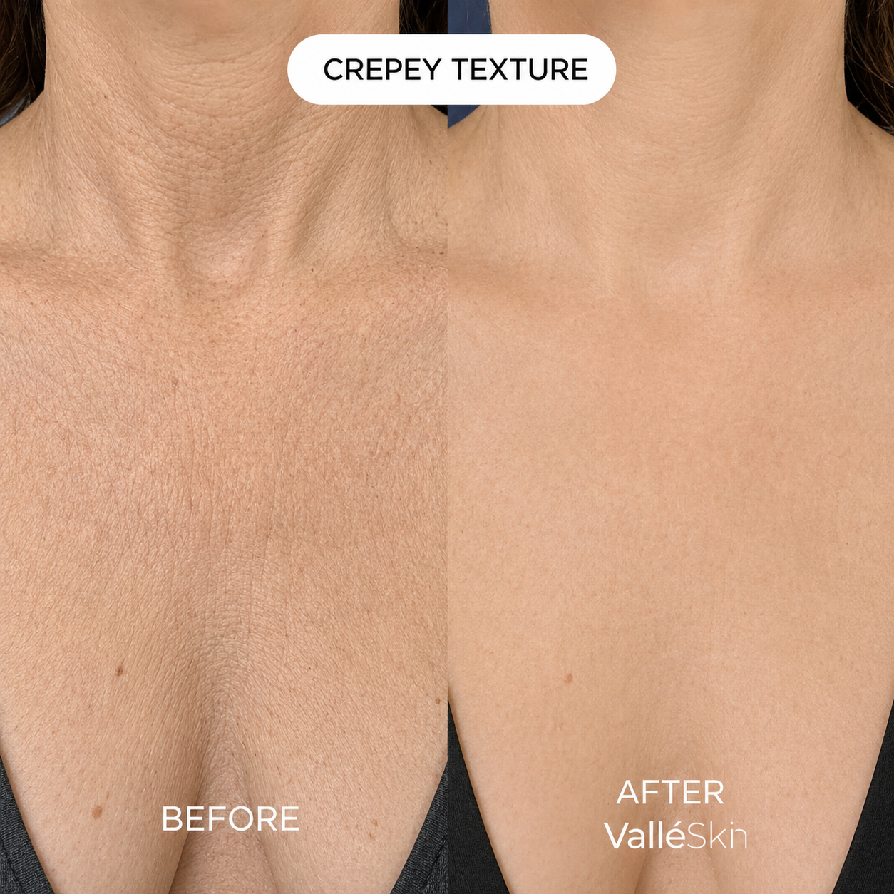 Collagen Chest Mask ValléSkin