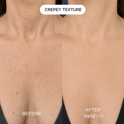 Collagen Chest Mask ValléSkin