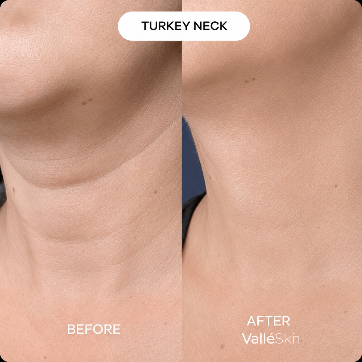 Collagen Neck Mask ValléSkin