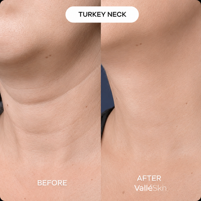 Collagen Neck Mask ValléSkin