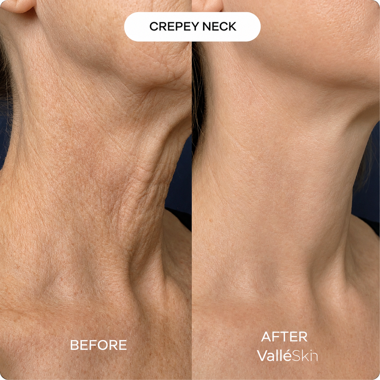 Collagen Neck Mask ValléSkin