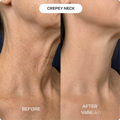 Collagen Neck Mask ValléSkin