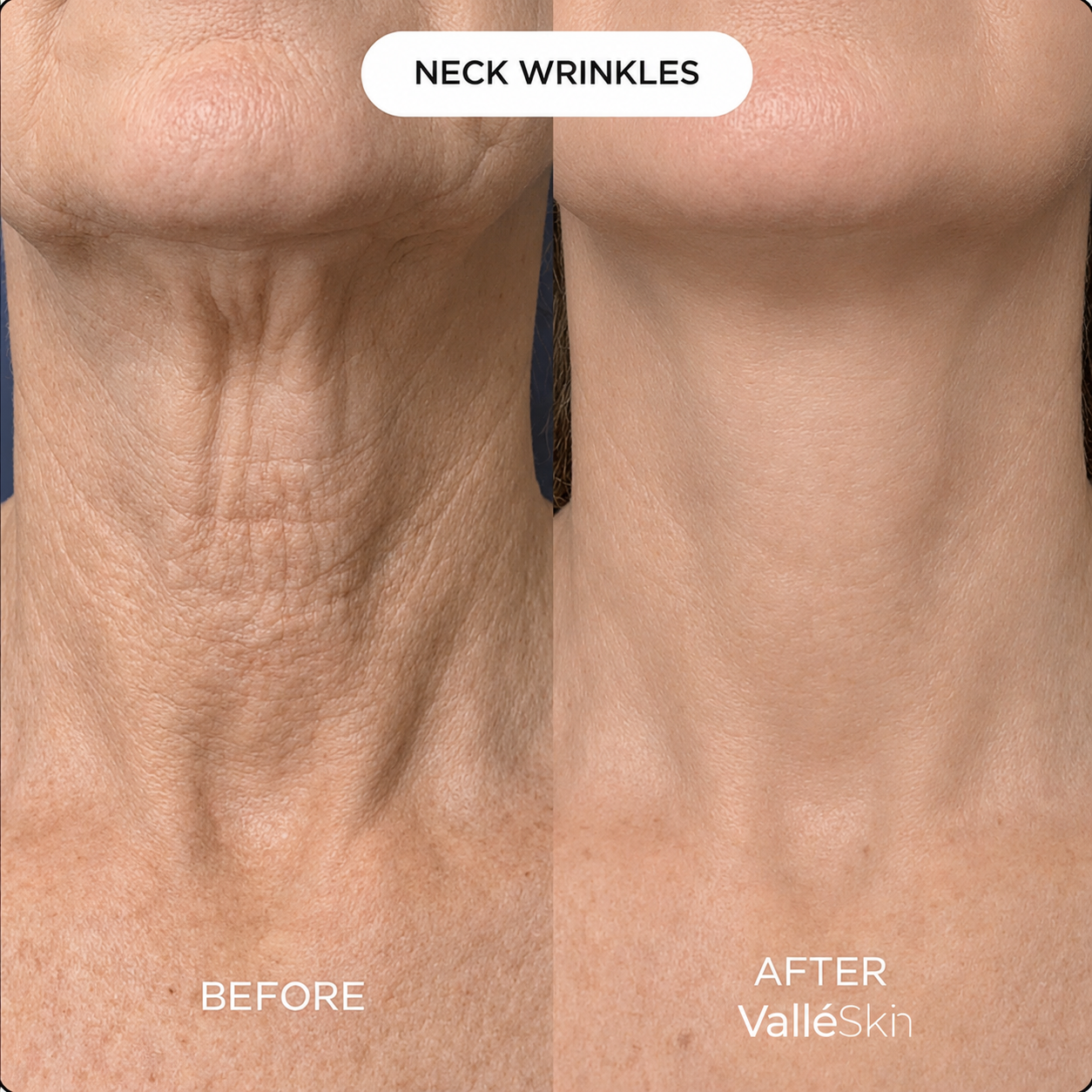Collagen Neck Mask ValléSkin